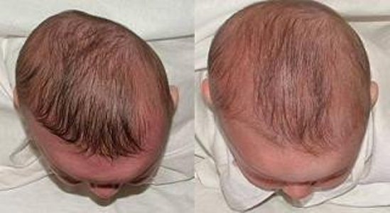 PLAGIOCEFALIA – نجاح خوذة علاج الرأس المسطح